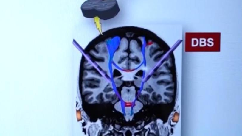 Chinese scientists identify core pathological brain network underlying Parkinson's disease